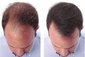 DERMO SUMAK – MINOXIDIL PREMIUM 5MG– 60 CÁPSULAS