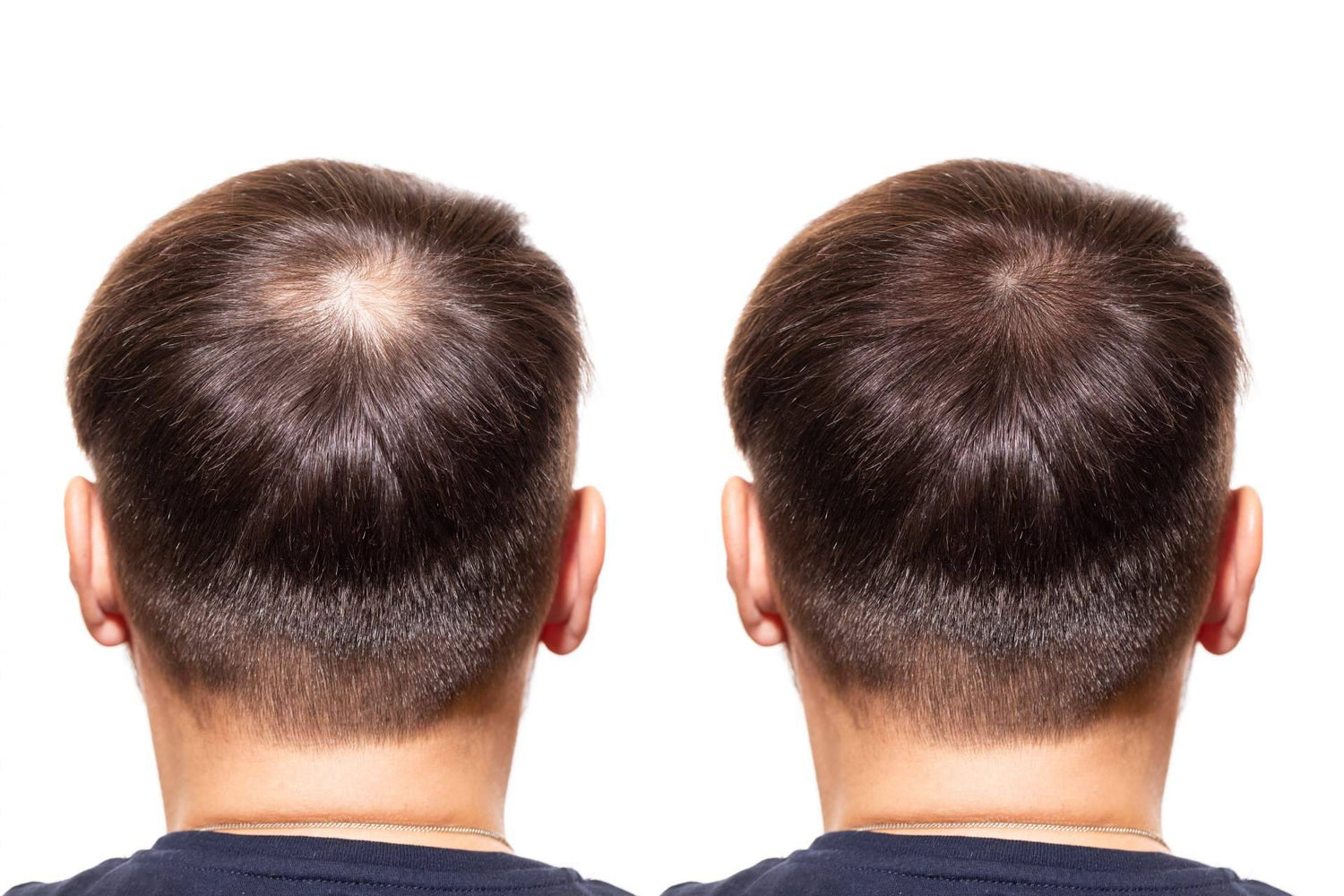 DERMO SUMAK – SUPLEMENTO PARA CRECIMIENTO CAPILAR – MINOXIDIL 5MG PREMIUM – 60 CÁPSULAS + REGALO DERMA ROLLER