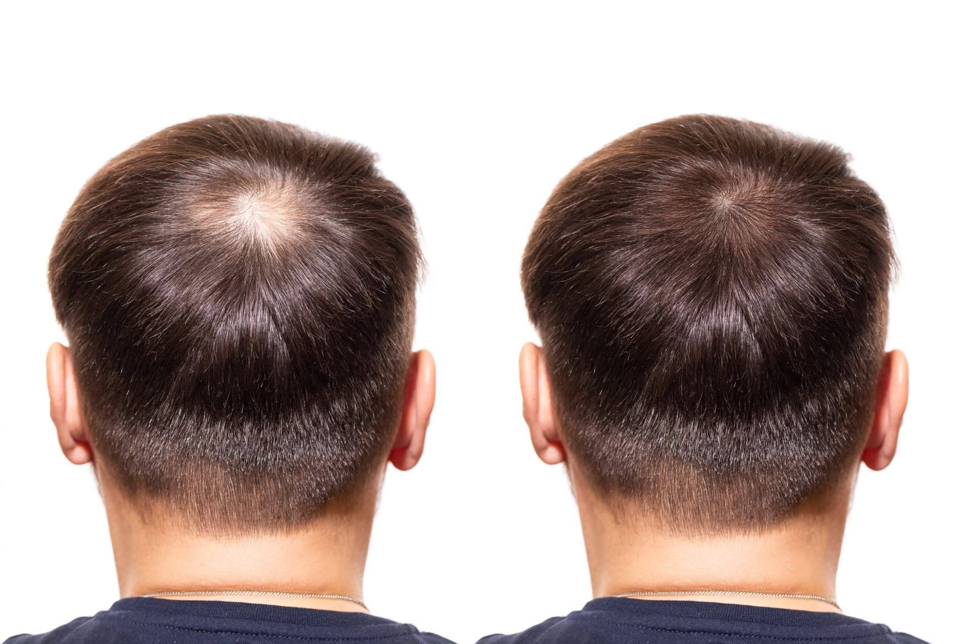 DERMO SUMAK – SUPLEMENTO PARA CRECIMIENTO CAPILAR – MINOXIDIL 5MG PREMIUM – 60 CÁPSULAS + REGALO DERMA ROLLER